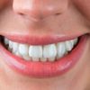 Как следить за эстетикой зубов